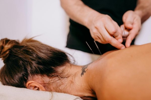 dry needling