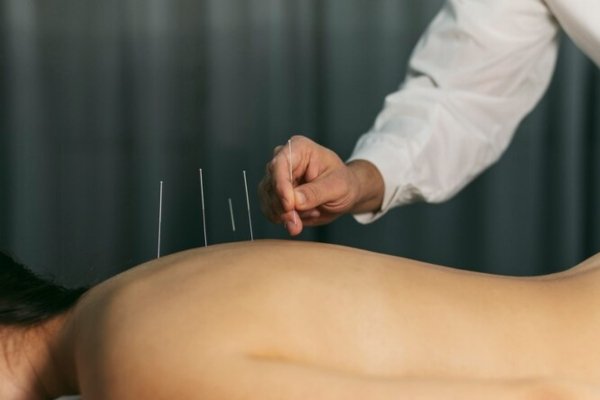 dry needling physio​