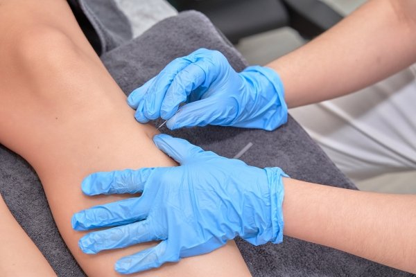 Dry Needling